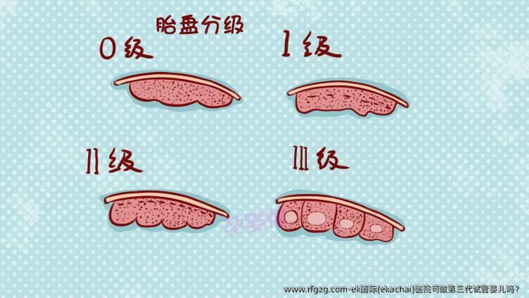 ek国际(ekachai)医院可做第三代代孕吗？